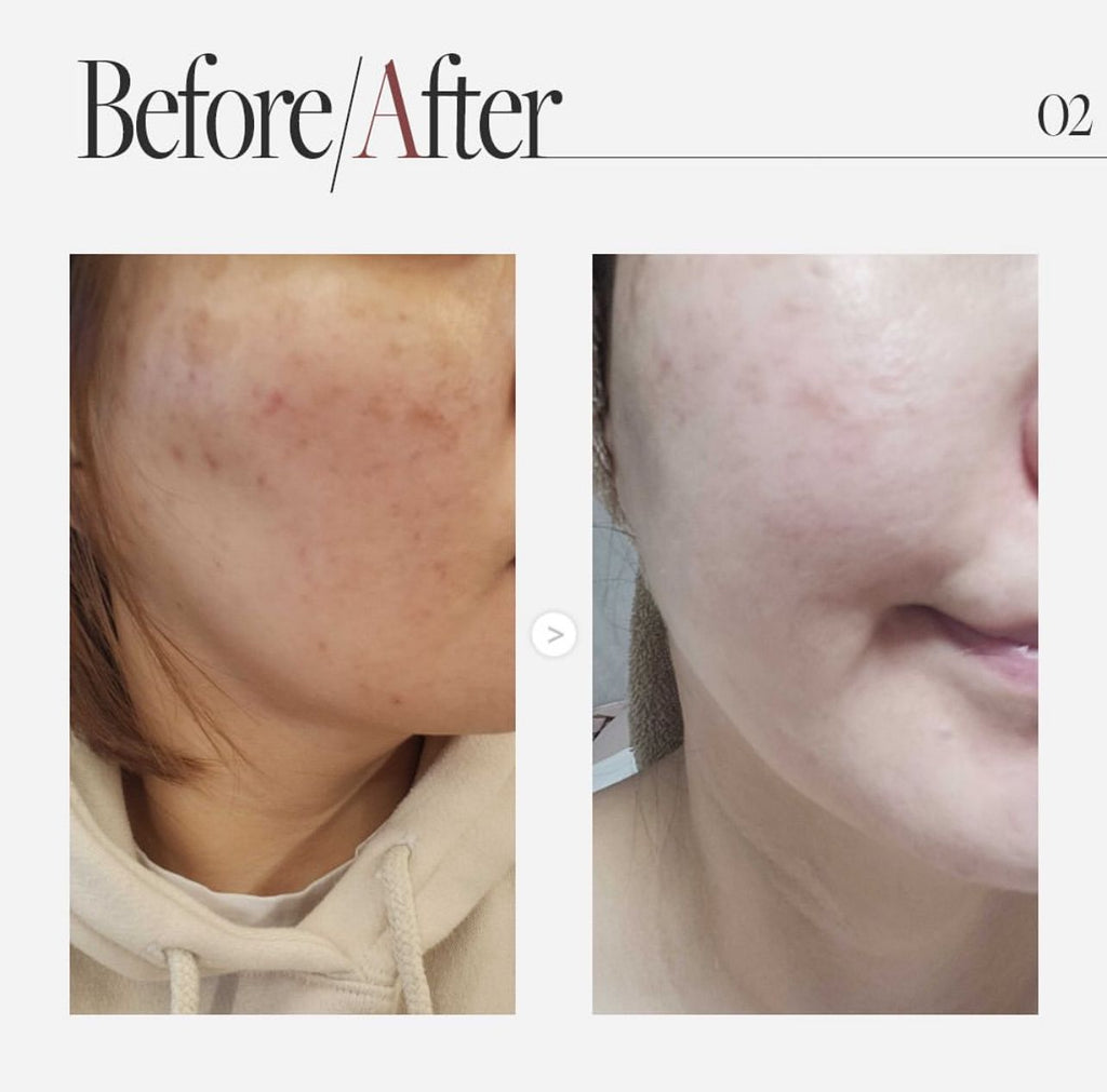 現貨🌸AUIO 膠原蛋白微針精華 300 | 落單後約3-5個工作天寄出