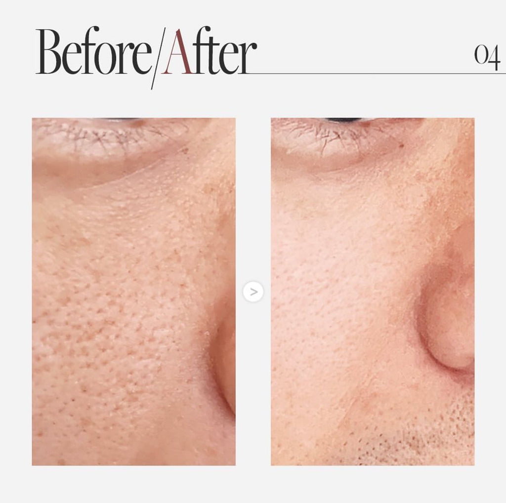 現貨🌸AUIO 膠原蛋白微針精華 300 | 落單後約3-5個工作天寄出