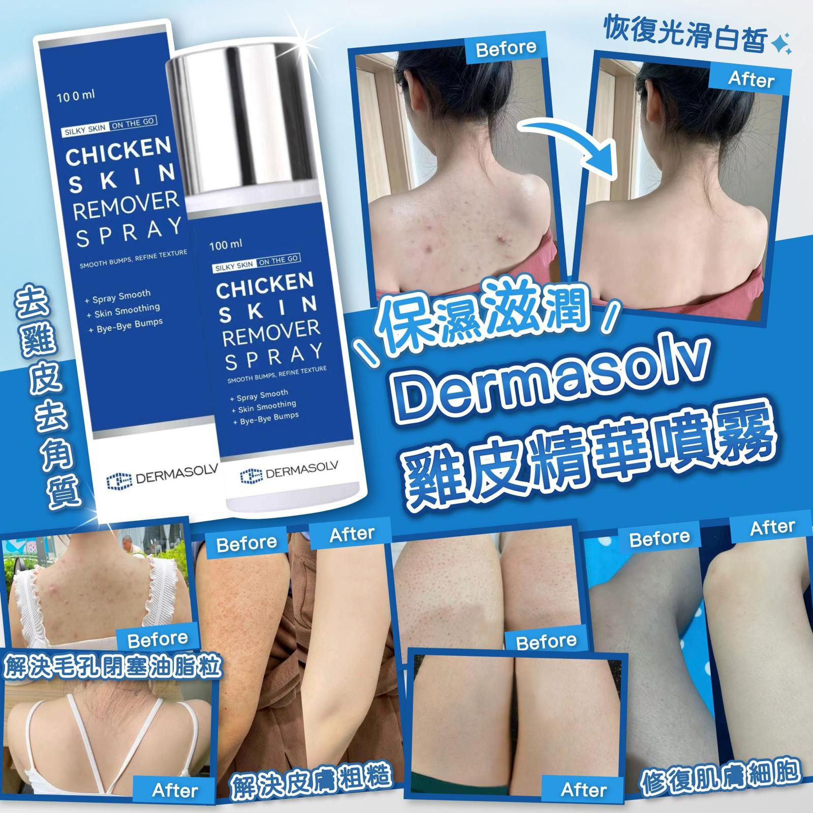 【24小時網站自助下單】🌸Dermasolv 雞皮精華噴霧 | 預訂約2-3星期 娉婷貿易公司 Exquisite Beauty Trading Company